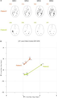 Geostatistical Analysis of White Matter Lesions in Multiple Sclerosis Identifies Gender Differences in Lesion Evolution